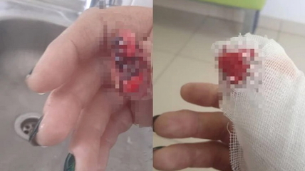 В барнаульской поликлинике женщине дверью «отрубили» палец и даже не извинились