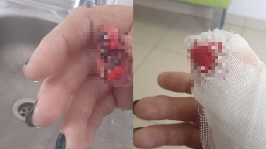 В барнаульской поликлинике женщине дверью «отрубили» палец и даже не извинились